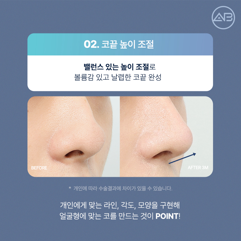 자려한직선코성형은 역시 에이비성형외과 관련 이미지 8