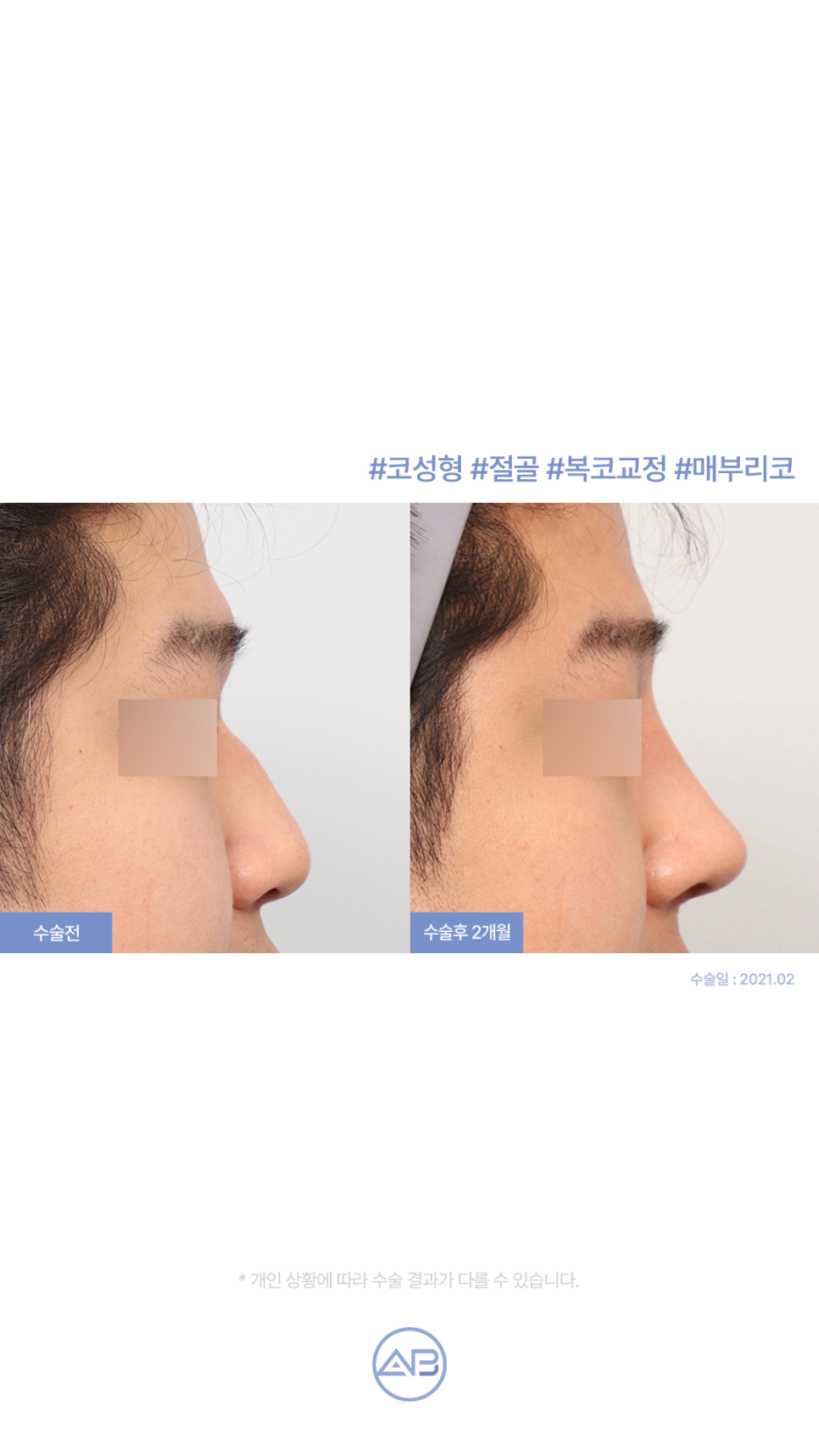 에이비성형외과 자려한코성형 수술전후 관련 이미지 2