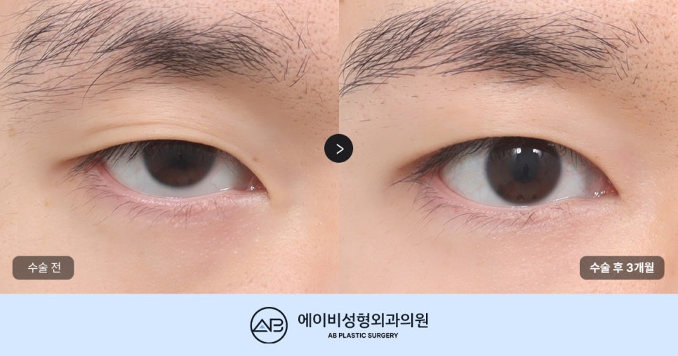 Key Points of Male Eye Surgery, Explained by AB! (Feat. Director Son Ji-hwan) image 1