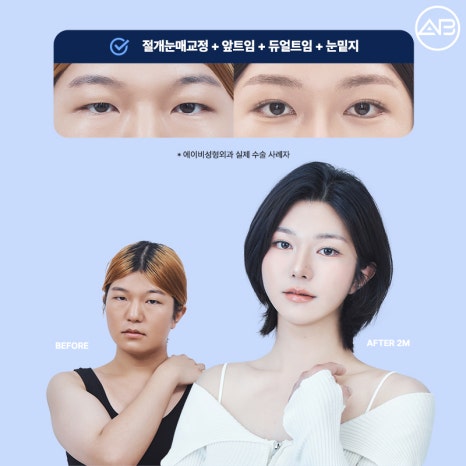 처음부터 예뻤던 것처럼, 에이비성형외과 자려한투명유착 관련 이미지 10