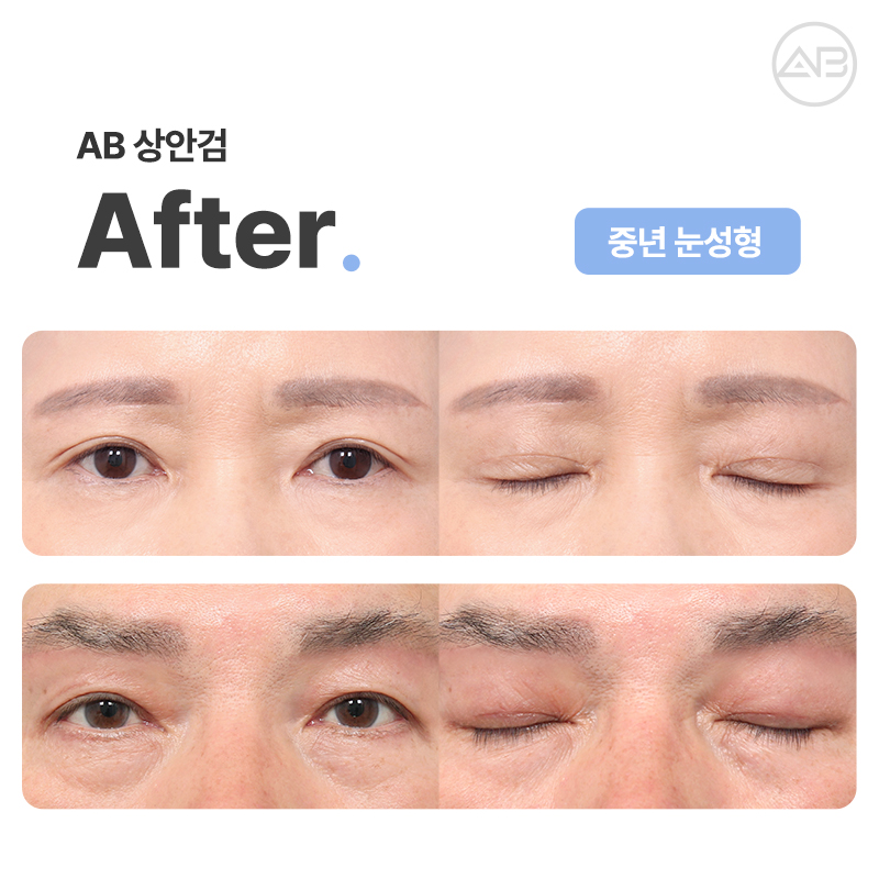 PRS KOREA 2024 : 에이비성형외과의 발표 내용과 성과 관련 이미지 13