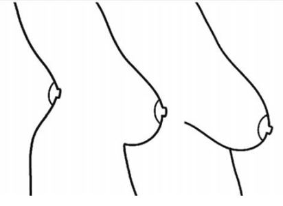 [Gynecomastia] Curious about gynecomastia and why it occurs... image 1