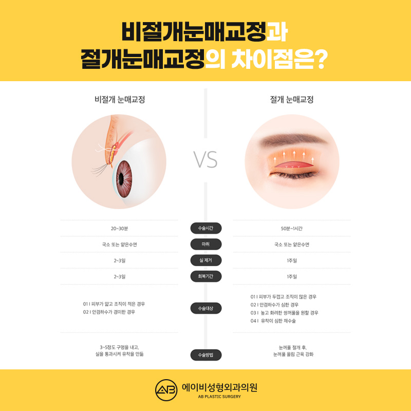 눈뜨는 힘이 부족하다면 에이비 안검하수눈매교정 관련 이미지 5