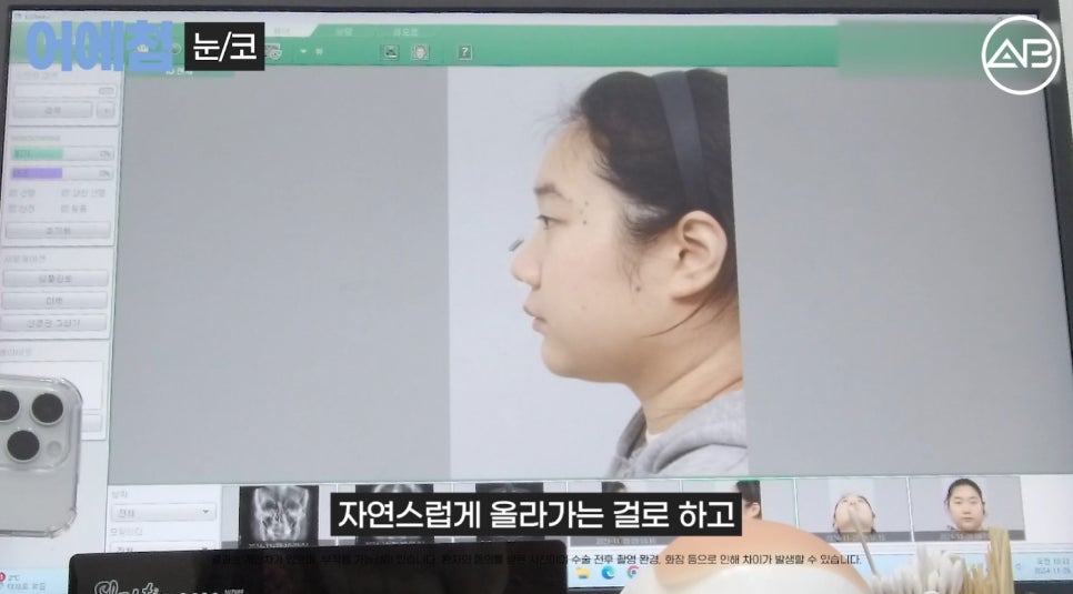 에이비성형외과 맥미걸(MAKEMEGirl) 맥미돌 코성형 상담 과정 관련 이미지 9