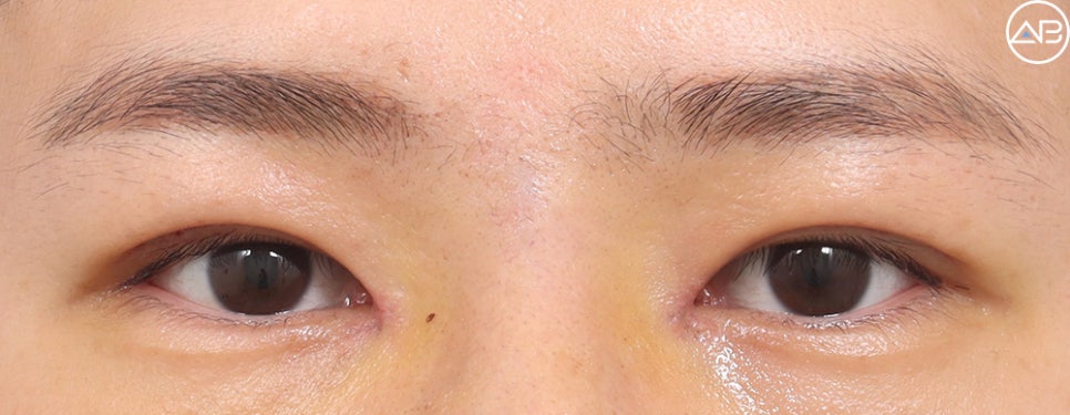 AB Plastic Surgery Male Eye Surgery Case Review (Feat. Director Ahn Moon-young) image 2