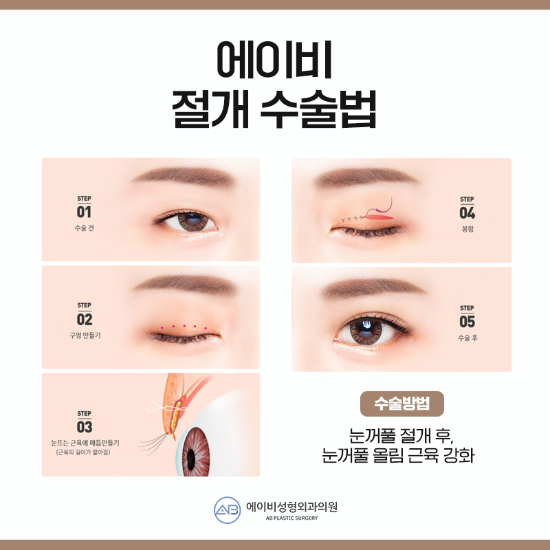 안검하수수술 부담없이 관련 이미지 5