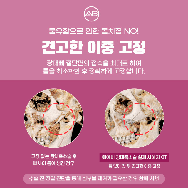AB성형외과 광대축소술 이라면 부드러운 광대라인 가능해 관련 이미지 5