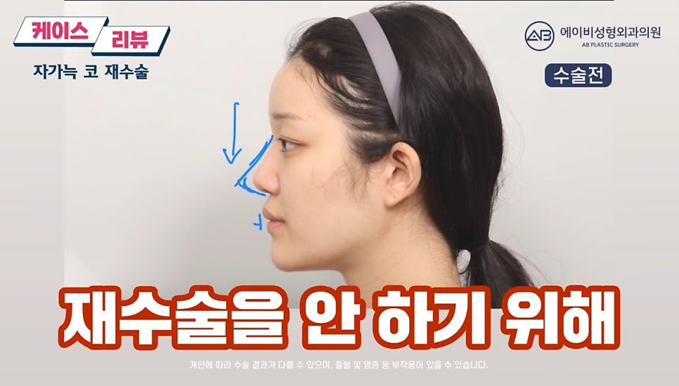 #에이비성형외과#에이비tv#케이스리뷰#코성형#코재수술 관련 이미지 2