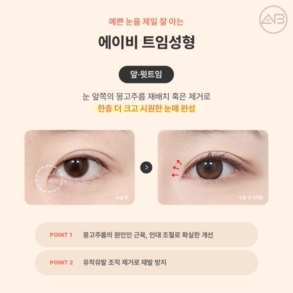 AB Plastic Surgery Eye Corner Surgery: Types and Reviews of Epicanthoplasty, Canthoplasty, and Lower Canthoplasty image 3