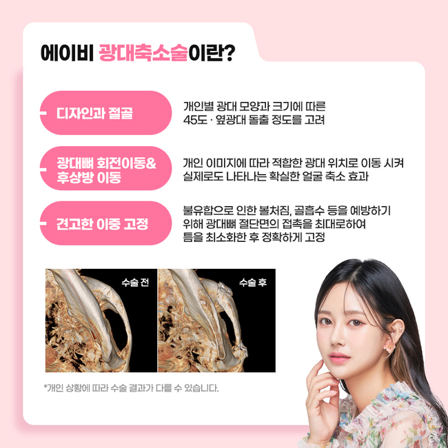 AB Plastic Surgery Clinic with Three Types of Facial Contouring, Different in Detail image 3