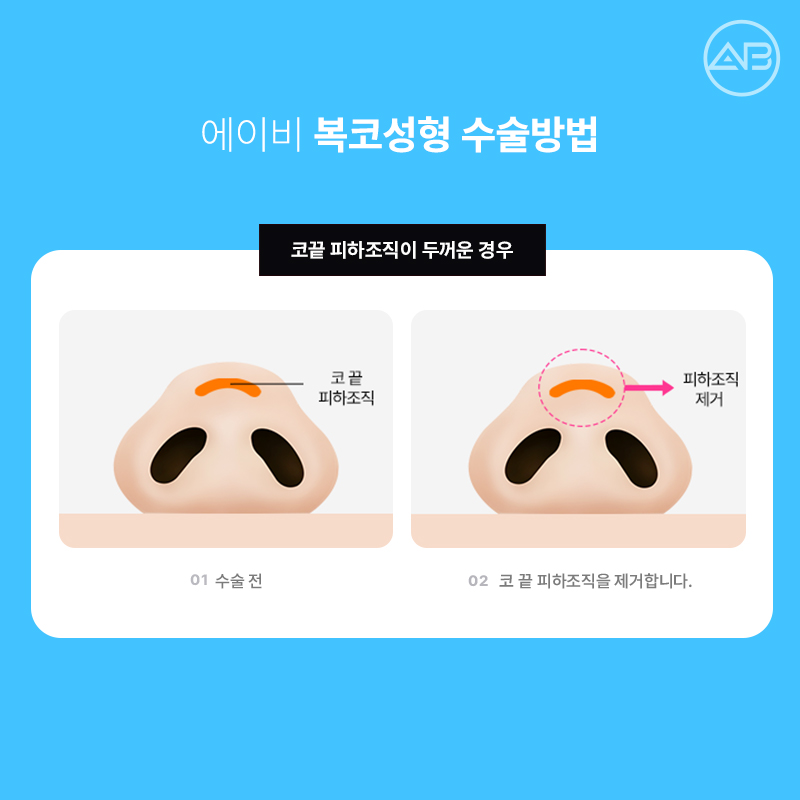 Why AB Plastic Surgery Is Famous for Bulbous Nose Surgery image 5