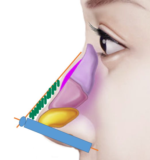 Q. Is it possible to have your first nose surgery without an implant? image 3