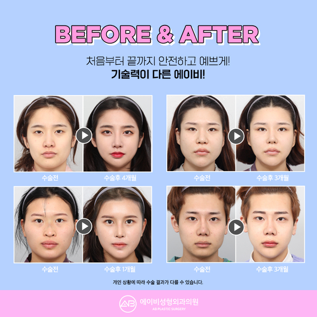 안면윤곽가격 아직도 고민된다면? 관련 이미지 4