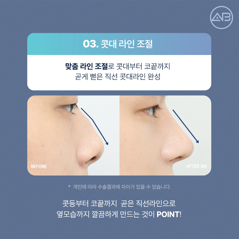 자려한직선코성형은 역시 에이비성형외과 관련 이미지 9