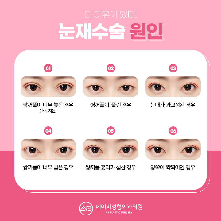 눈재수술유명한곳 하면 에이비성형외과 아닐까 관련 이미지 3