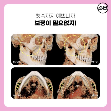 자려한안면윤곽 원한다면 AB성형외과 관련 이미지 8