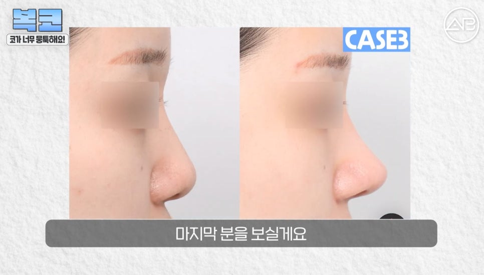 #에이비성형외과#에이비tv#코성형#복코성형 관련 이미지 20