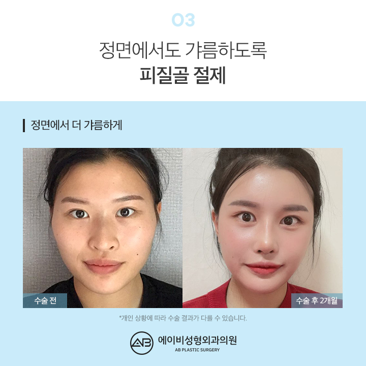 사각턱수술후기 기대가 되지 관련 이미지 4