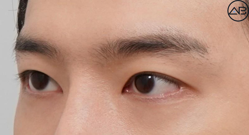 AB Plastic Surgery Men’s Eye Surgery - First Snow Case Review image 5