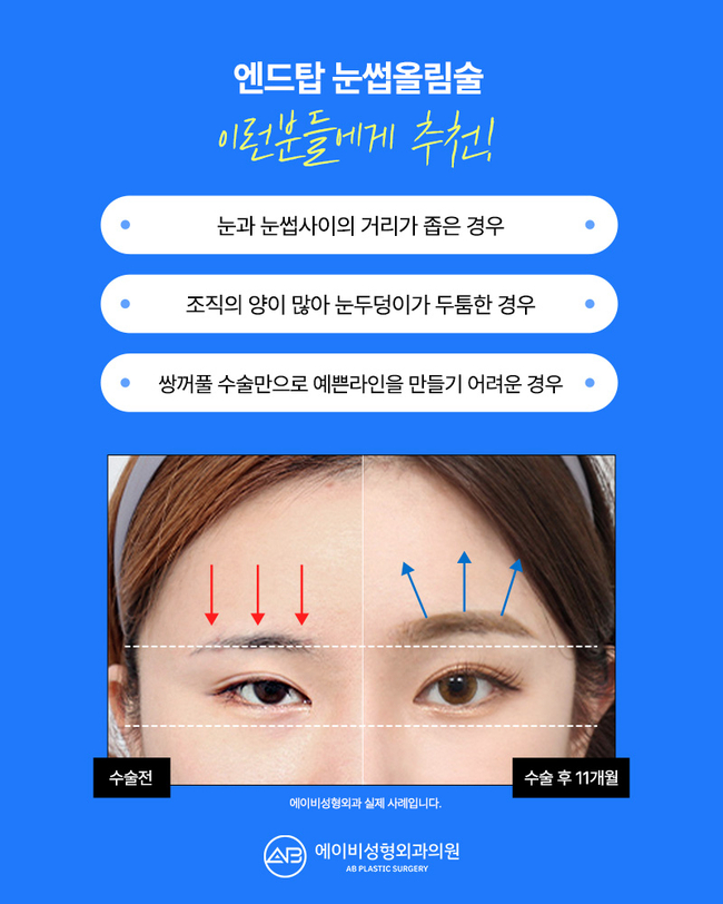 If You’re Still Thinking About a Brow Lift image 2