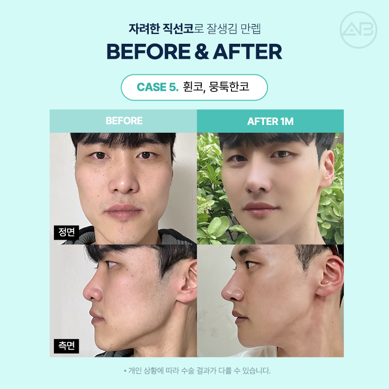남자직선코성형 왜 에이비성형외과일까? 관련 이미지 14