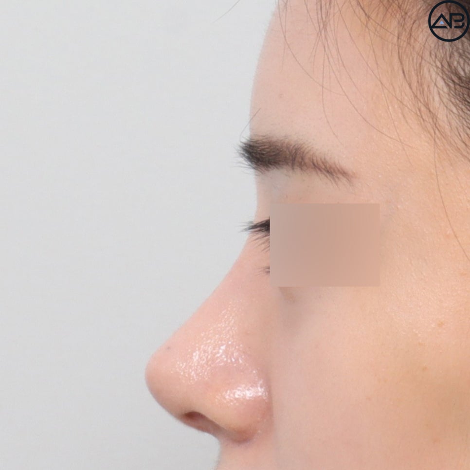 AB Plastic Surgery Refined Rhinoplasty - Revision Surgery Case Review image 4