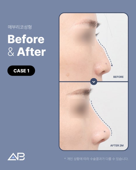 매부리코성형 자연스럽게 교정 원한다면 AB성형외과 관련 이미지 4