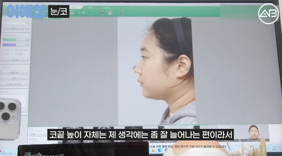 에이비성형외과 맥미걸(MAKEMEGirl) 맥미돌 코성형 상담 과정 관련 이미지 7