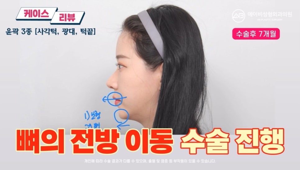 #에이비성형외과#에이비tv#케이스리뷰#윤곽3종수술 관련 이미지 8