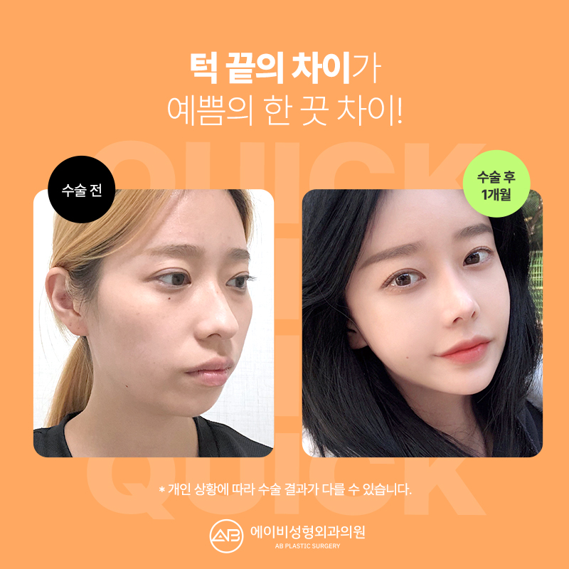 AB Plastic Surgery with Many Facial Contouring Reviews image 2