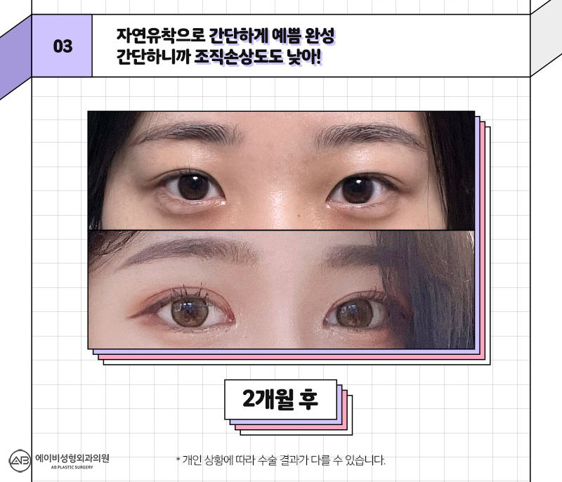 중학생쌍꺼풀수술 에이비라서 다르다 관련 이미지 5