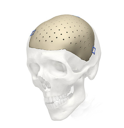 Q. There are so many materials for nose surgery. Which material should be used to reduce side effects? I’m not really sure what the difference is! image 2