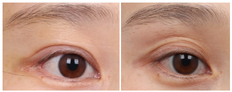 [Column] Can Sunken Eyelids Be Improved Too? image 7