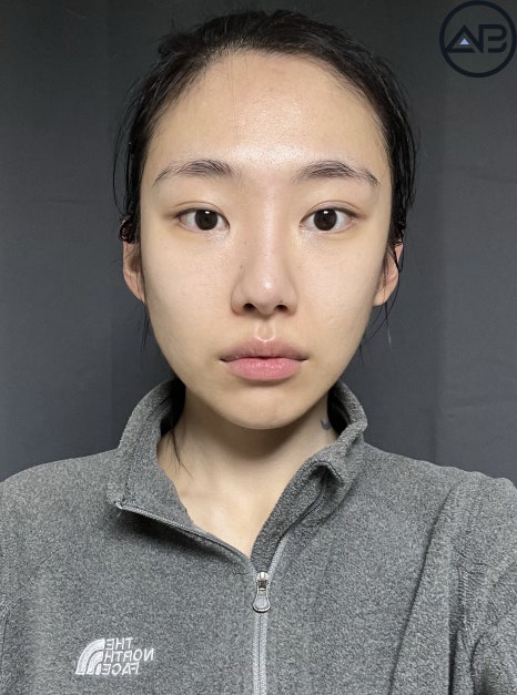 AB성형외과 예쁜애 옆에 예쁜애 후기 모음집 관련 이미지 7
