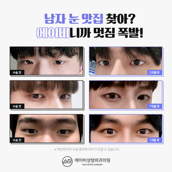 에이비성형외과 썸남눈성형 이게 뭔데? 관련 이미지 3