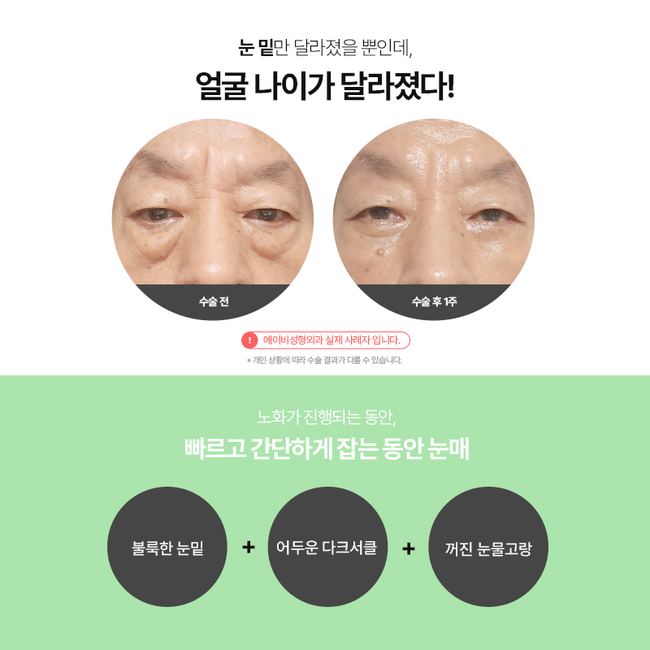 Differences in AB Plastic Surgery’s Mini Lower Blepharoplasty image 2