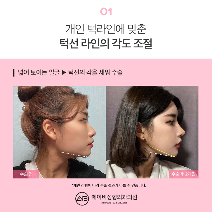 사각턱수술후기 기대가 되지 관련 이미지 2