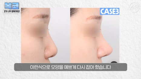 #에이비성형외과#에이비tv#코성형#복코성형 관련 이미지 23
