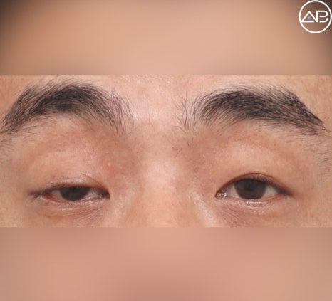 Severe Ptosis: Which Surgery Is Effective? image 3