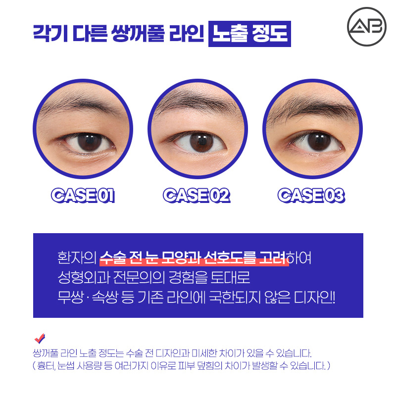 남자쌍수후기 시원하고 자연스럽게 에이비성형외과 관련 이미지 3