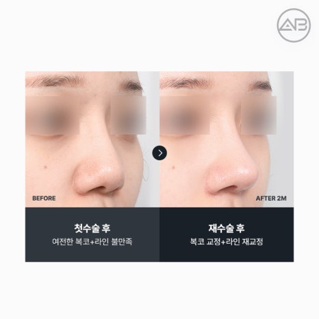 코재수술 필요하다면 에이비성형외과 관련 이미지 20