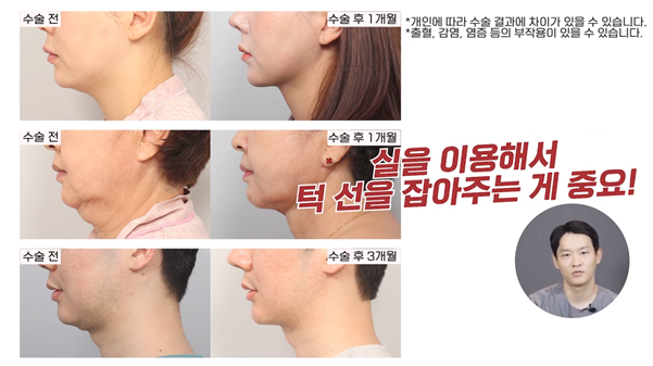 #에이비성형외과#에이비TV#이중턱지방흡입#엘라스티꿈 관련 이미지 7