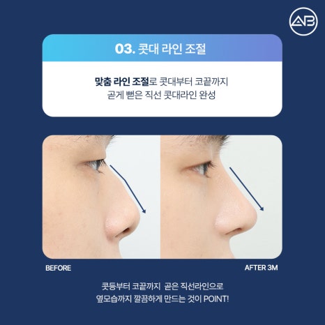 AB Plastic Surgery: What’s Different About an Elegant Male Straight Nose Surgery? image 7