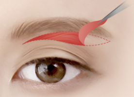 Q. The space between my eyebrows and eyes is narrow, and my eyelids are droopy, so I’ve consulted several places, but everyone recommends something different. What are the differences between ptosis correction, forehead lift, and brow lift under the eyebrow? image 3
