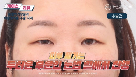 #에이비성형외과#에이비tv#케이스리뷰#중년눈성형 관련 이미지 4