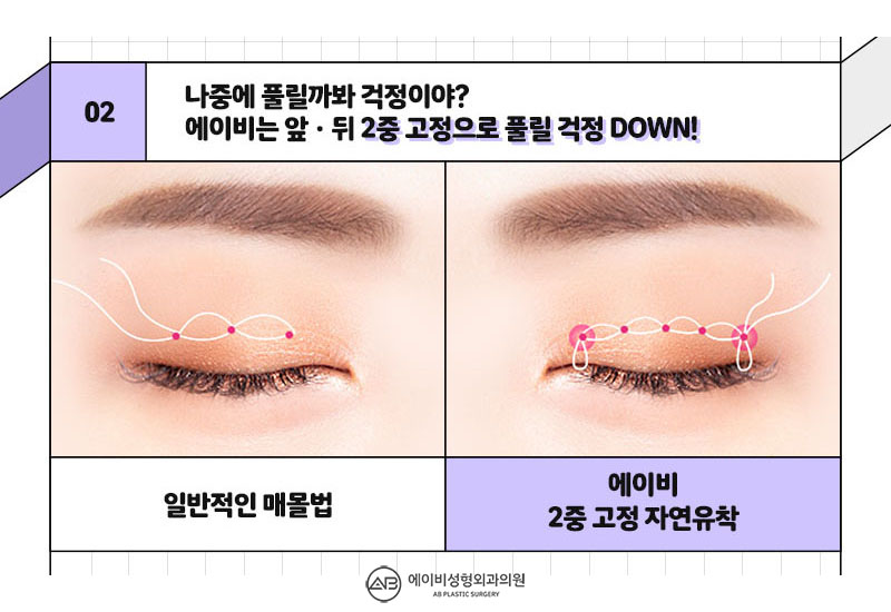 중학생쌍꺼풀수술 에이비라서 다르다 관련 이미지 4