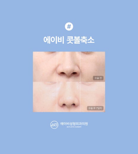 에이비성형외과 콧볼축소 수술전후 관련 이미지 6