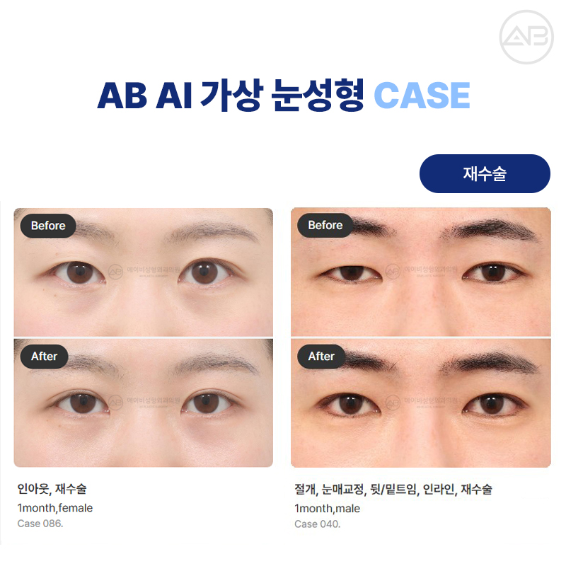 에이비성형외과 AI 가상 눈성형 원하는 결과를 미리 볼 수 있다! 관련 이미지 4