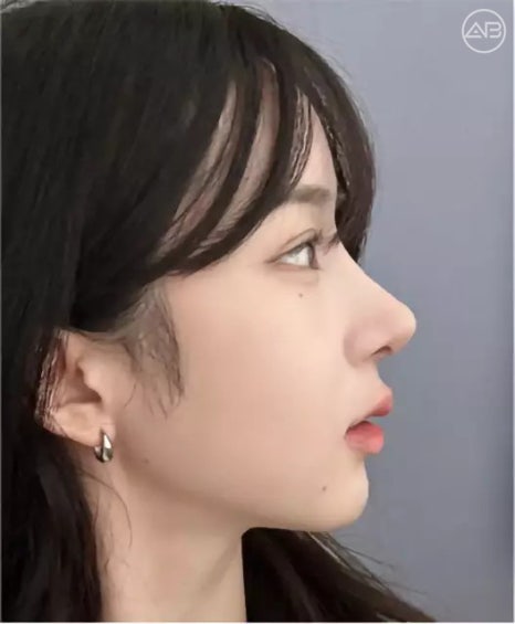 에이비성형외과 자려한 비주라인 코성형수술 관련 이미지 1