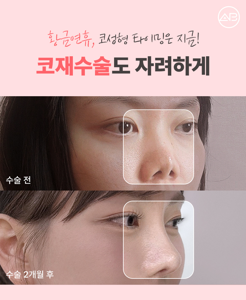 에이비성형외과 5월 황금연휴 이벤트 소식 관련 이미지 5